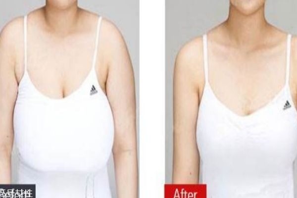 缩胸手术是什么,缩胸手术是什么原理