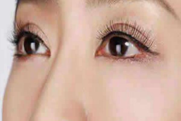 夏天割双眼皮好吗,夏天割双眼皮好还是冬天割好 夏天割双眼皮好吗,夏天割双眼皮好还是冬天割好