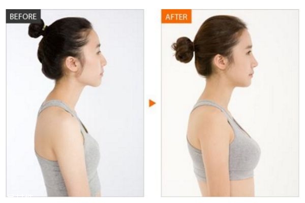 假体隆胸的假体能维持多少年?,假体隆胸要多久才会变软