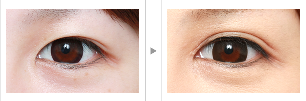 怎样放大双眼,睁大眼睛变成双眼皮