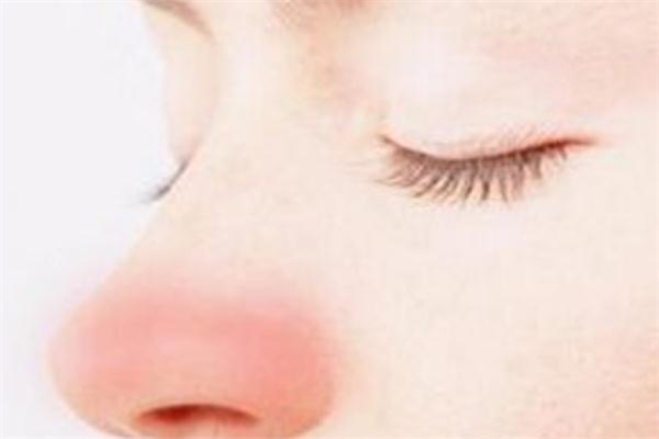 酒糟鼻是怎样形成的,酒糟鼻子是什么样子的