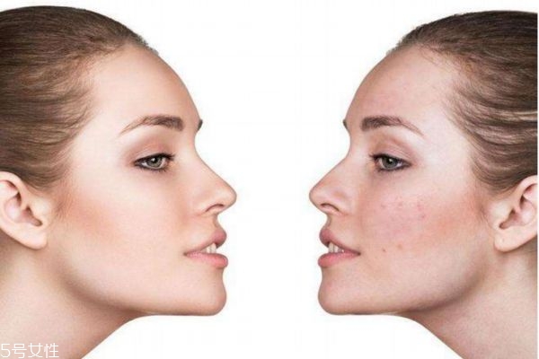 果酸换肤多久有效果,果酸换肤能维持多长时间