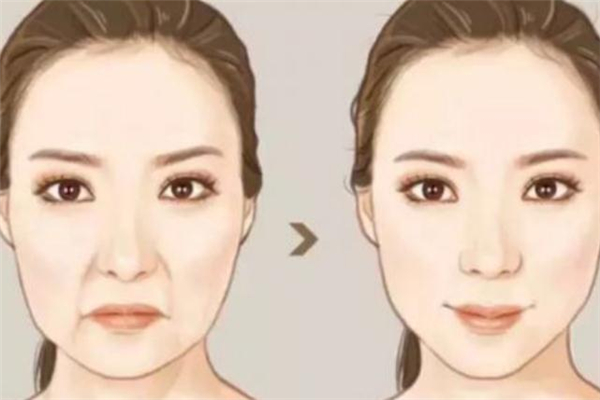 自体脂肪填充鼻唇沟的效果,脂肪填充鼻唇沟效果好吗