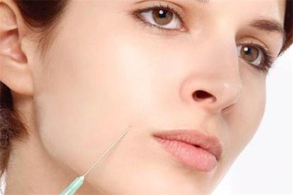 鼻唇沟玻尿酸填充要几支,玻尿酸填鼻唇沟一年后的真相