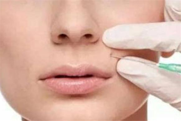 玻尿酸填充鼻唇沟效果好吗,玻尿酸填充鼻唇沟效果如何