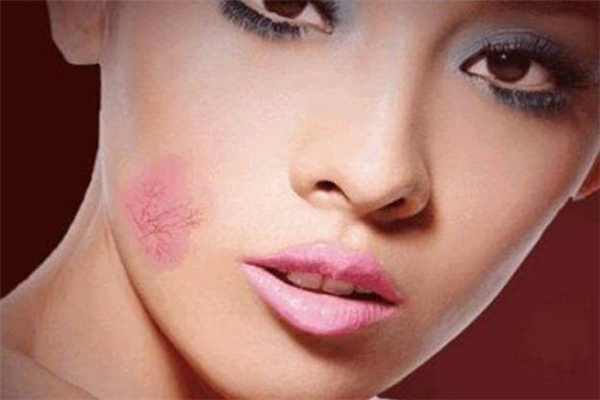 激光祛红血丝疼吗?,激光祛红血丝疼不疼