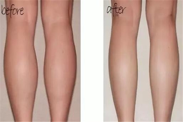 瘦腿针每次要打几针,瘦腿针打多少次