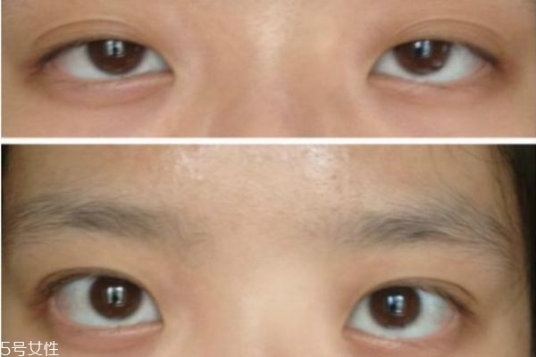 上眼睑下垂可以治愈吗,眼睑下垂可以治愈吗