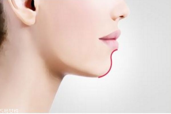 下巴填充多久恢复正常,垫下巴多久恢复自然