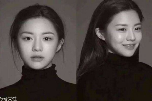 激光祛痘印后反黑怎么办,激光祛痘印的地方变黑了