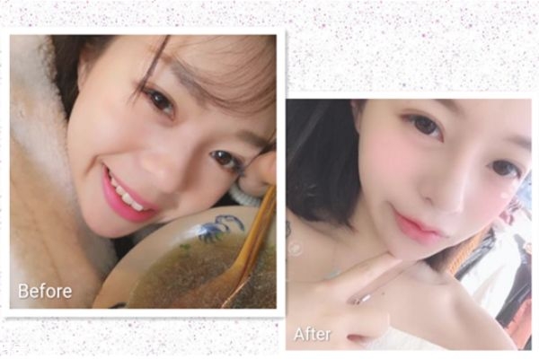 缩鼻翼手术前后对比照,鼻翼缩小手术对比效果图