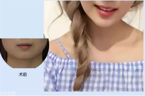 垫下巴前后对比照片 硅胶,垫下巴前后对比效果图 垫下巴前后对比照片 硅胶,垫下巴前后对比效果图