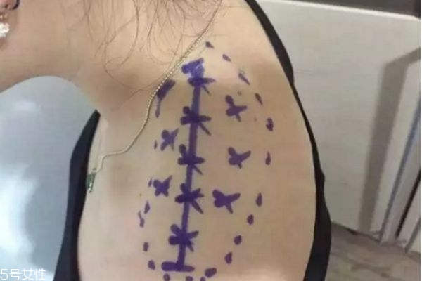 瘦肩针注射位置图打法,瘦肩针注射位置图片