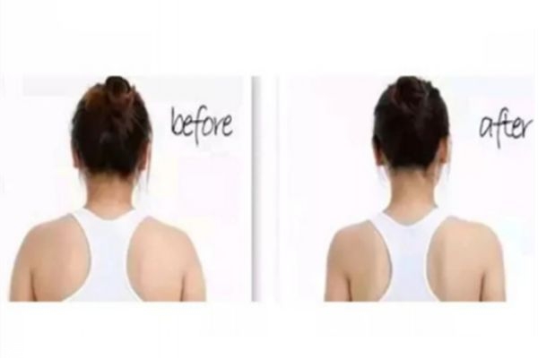 瘦肩针前后对比照片,瘦肩针的效果图