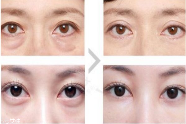 眼袋是外切好还是内切好,眼袋手术内切和外切哪个好