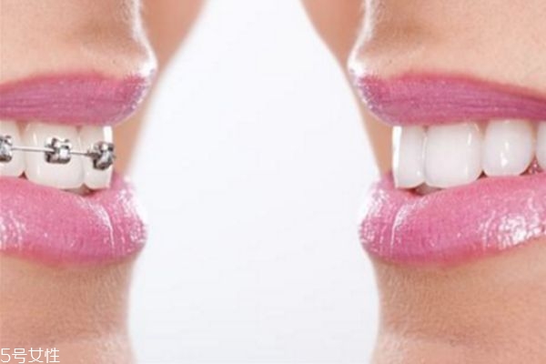 美容冠矫正牙齿效果好不好,美容牙冠好还是矫正牙齿好