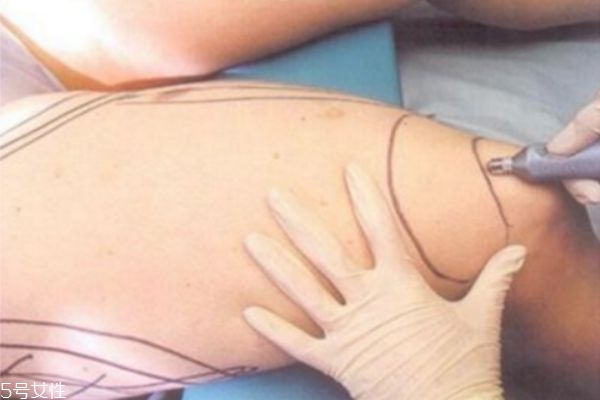 大腿吸脂多久可以完全消肿,大腿吸脂肿胀期多久