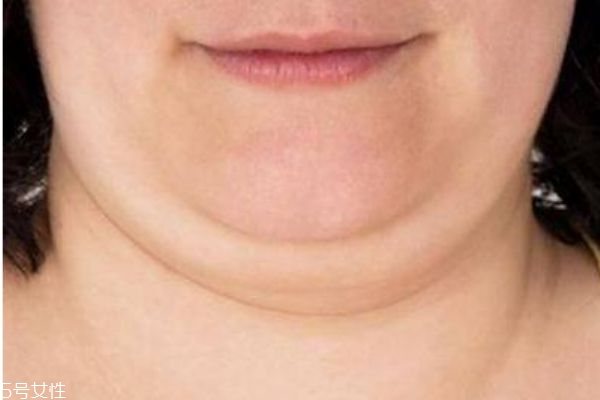 做面部吸脂风险大吗,面部吸脂安全吗