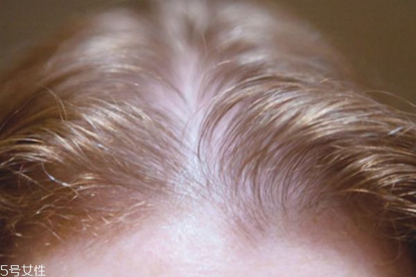 哪些人不适合植发,什么情况下不能植发