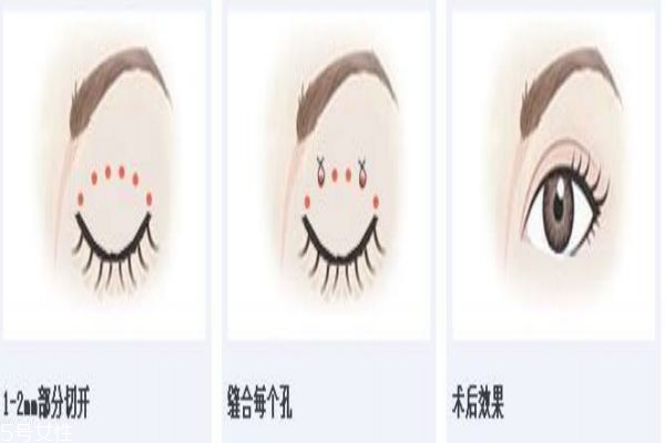 什么是韩式三点双眼皮,韩式三点双眼皮认准当代美容优