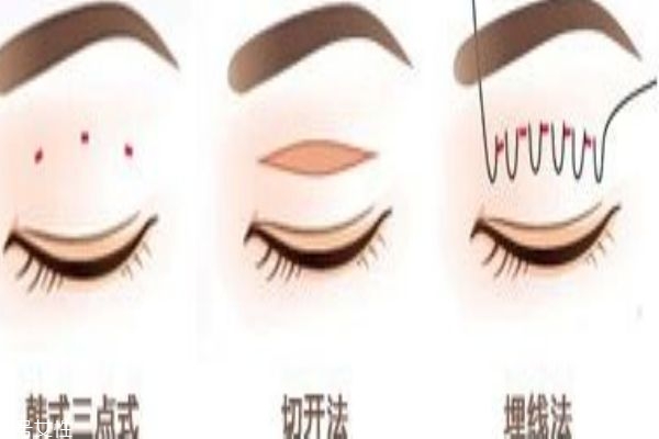韩式三点双眼皮和埋线的区别,韩式三点和埋线的区别 韩式三点双眼皮和埋线的区别,韩式三点和埋线的区别