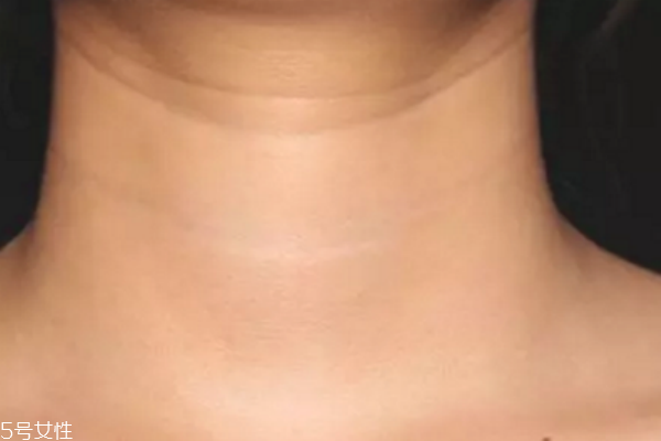 激光去颈纹有用吗,激光可以去颈纹吗 激光去颈纹有用吗,激光可以去颈纹吗