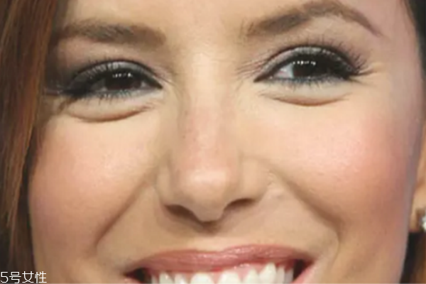 鱼尾纹能打玻尿酸吗,玻尿酸填充鱼尾纹