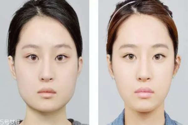 美容用肉毒素有什么作用,下颌缘打肉毒素有什么作用