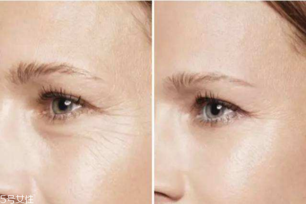 激光去鱼尾纹价格是多少钱,做鱼尾纹大概多少钱呢