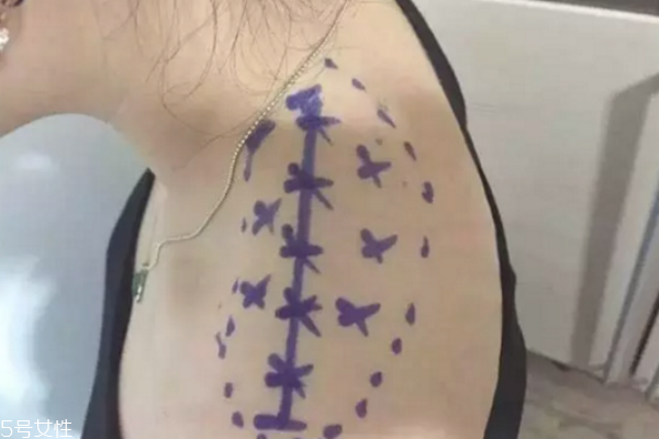 瘦肩针打哪个部位,瘦肩针打哪个部位图解