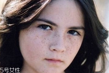 皮秒对色素沉淀有效果吗,皮秒以后留下的色素沉着多长时间能恢复