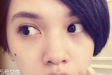 药水点痣是什么原理,药水点痣的原理是什么意思 药水点痣是什么原理,药水点痣的原理是什么意思