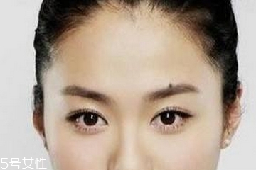 点痣是挂什么科室,点痣预约什么科室