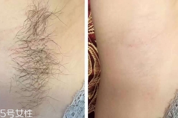 超冰脱毛原理是什么,超冰脱毛原理介绍