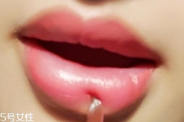 打完嘟嘟唇可以冰敷吗,嘟嘟唇可以冰敷吗