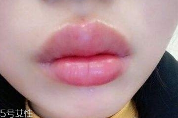 玻尿酸嘟嘟唇多少钱一针,嘟嘟唇一针多少钱