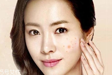 祛痘手术需要多少钱,祛痘手术需要多少钱一次 祛痘手术需要多少钱,祛痘手术需要多少钱一次