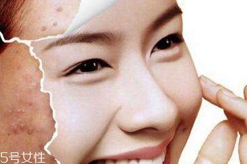 祛痘手术有哪些,祛痘手术有哪几种