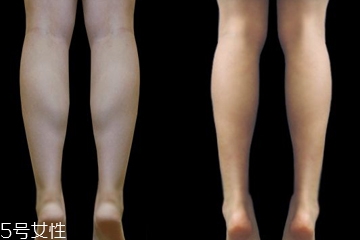 瘦小腿可以手术吗?,瘦小腿需要多久 瘦小腿可以手术吗?,瘦小腿需要多久