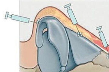 鼻尖用什么材质做最好,鼻尖一般用什么材料做