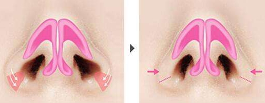 鼻翼缩小术后注意事项,鼻孔缩小术千万别做 鼻翼缩小术后注意事项,鼻孔缩小术千万别做
