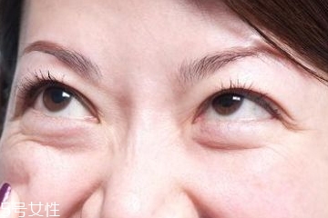 眼袋手术几天拆线最好,做眼袋几天拆线