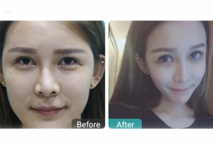 做眼睑下至多久恢复,上睑下垂术后多久恢复自然