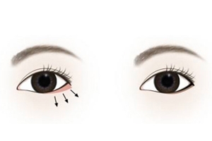 下眼睑手术会不会留疤,上眼睑下垂手术会留疤吗