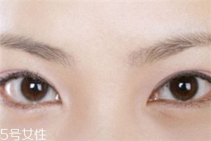 割完双眼皮怎么样恢复得更好,双眼皮怎么恢复比较快