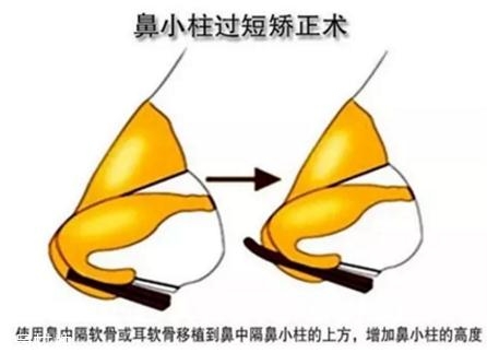 鼻小柱延长用什么材料最好,鼻小柱延长用什么材料不吸收