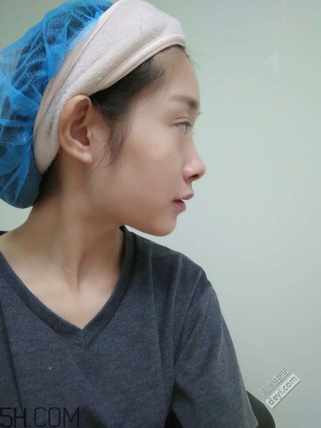 鼻头缩小术过程图,鼻头缩小手术过程 鼻头缩小术过程图,鼻头缩小手术过程