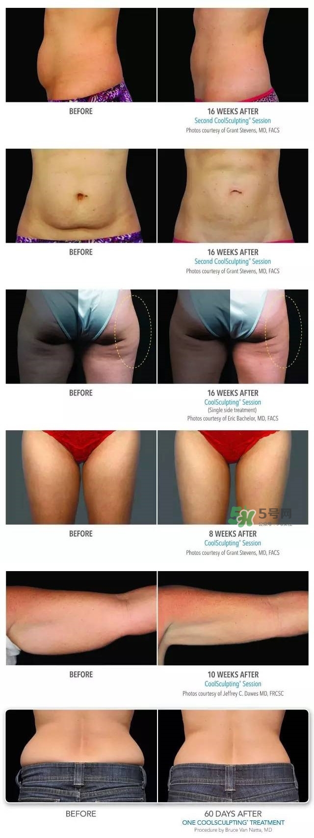 酷塑溶脂效果怎么样,冷冻溶脂/酷塑副作用