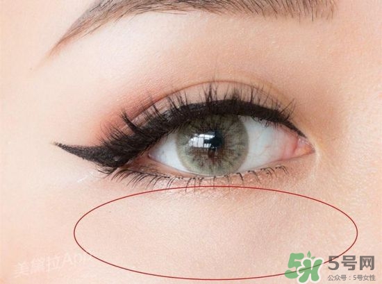 玻尿酸填充泪沟多久可以恢复自然,玻尿酸填充泪沟恢复期