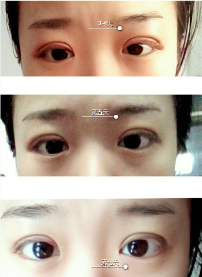 双眼皮三点定位是永久的吗,三点双眼皮是永久的么
